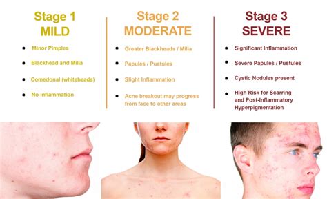 What Type Of Acne Do You Have Types Of Acne Explained Skinive Free