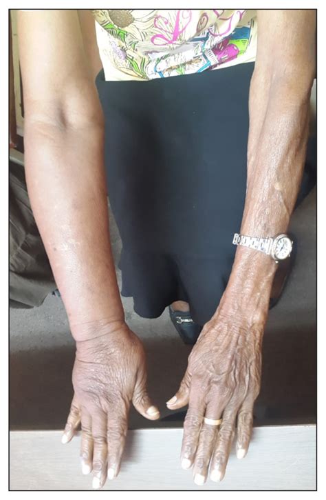 Primary Upper Limb Lymphedema Case Report Of A Rare Pathology The