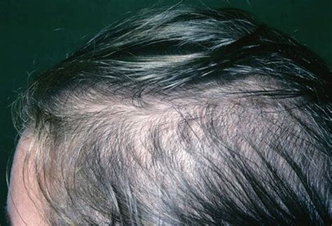 Some researchers say that dht causes pattern hair loss. Female Pattern Baldness Picture Image on MedicineNet.com