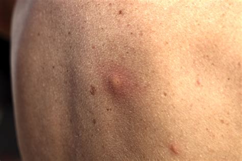 These Bug Bite Pictures Can Help You Identify A Mosquito Bite Tick
