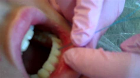 Here are some tips on how to correctly floss with a permanent retainer. Orthodontist Rogers, AR floss DBL (permanent retainer ...