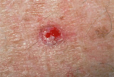 Basal Cell Carcinoma On Skin On The Back Photograph By Dr P Marazzi