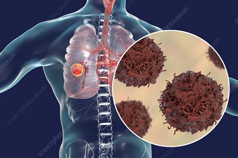 Lung Cancer Illustration Stock Image F0221935 Science Photo Library