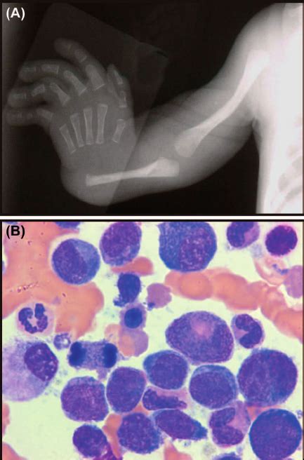 Phenotypic Features Of Thrombocytopenia With Absent Radii Tar