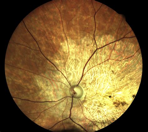 Retinal Artery Occlusioneidon