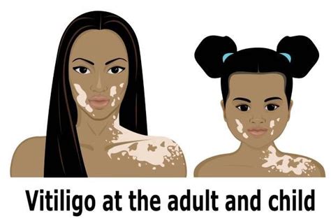 Tratamento P Vitiligo Dr Michael Dawson Vitiligo Reviews Vitiligo