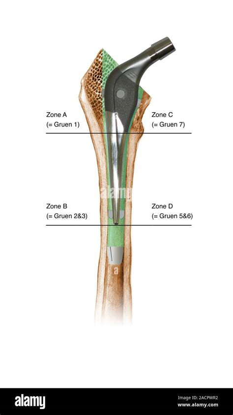 Prosthetic Hip Joint And Gruen Zones Cutaway Diagram Of A Femur Thigh
