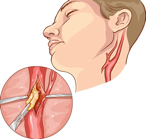 Carotid Endarterectomy Surgery Recovery Timeline Hot Sex Picture