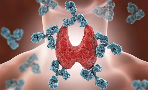 Una descrizione dei segni e dei sintomi dei rischi delle malattie autoimmuni 3. Tiroide di Hashimoto | i sintomi e come si riconosce la ...