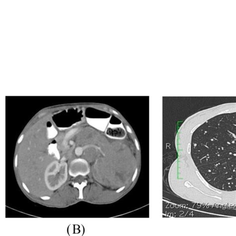 A Contrast Ct Scan Imaging Of Abdomen And Pelvis In 3a Sagittal And