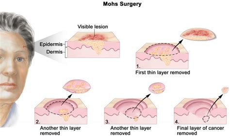 Mohs Case Before And After Infiltrative Basal Cell Carcinoma