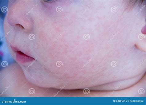 Allergy Baby Skin Dermatitis Food Child Dermatitis Symptom Problem
