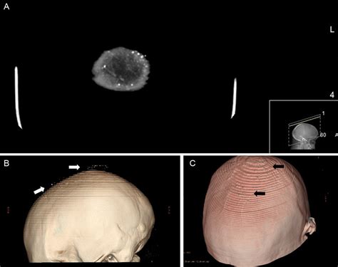 Head Computed Tomography A Punctiform Cutaneous Lesions With High