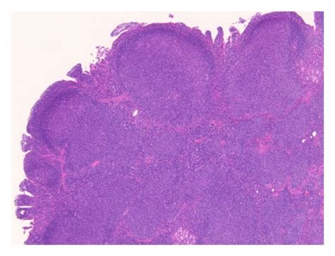Representative Histologic Images Of The Follicular Lymphoma Ad