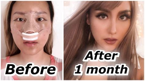 Rhinoplasty 1 Month Update Before And After Id Hospital Surgery Part 2
