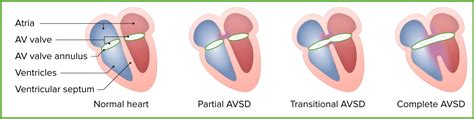 Atrioventricular Septal Defect Avsd Concise Medical Knowledge