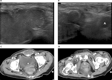Sonography Of Various Cystic Masses Of The Female Groin Oh 2007