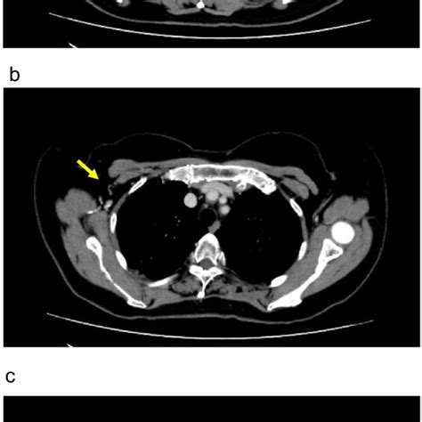 Contrast Enhanced Ct Imaging After Preoperative Chemotherapy A The