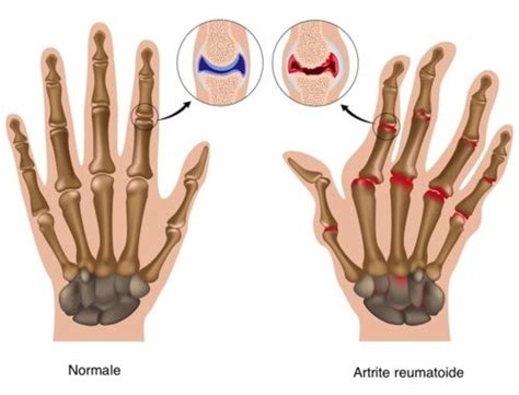 Quando il cane espelle cibo non ancora digerito e che si presenta dunque ancora parzialmente intero, si parla di rigurgito. Artrite: sintomi, cause, tutti i rimedi - Cure-Naturali.it