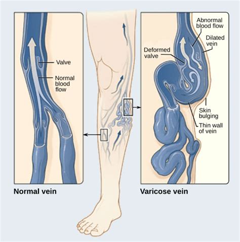 What You Need To Know About Vein Valves Vein Clinics Of America Now