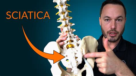 Understanding Sciatica Everything You Need To Know About The Causes
