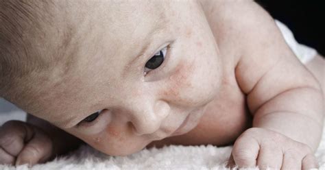 Dry Skin On A Babys Face Causes And Remedies
