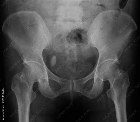 X Ray Image Of Bladder Showing Bladder Stone Stock Photo Adobe Stock