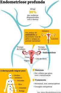 Die therapie bei endometriose hängt von der individuellen situation der frau ab. Dor crônica pode ser sinal de endometriose
