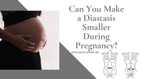 How To Make A Diastasis Smaller During Pregnancy Diastasis Recti