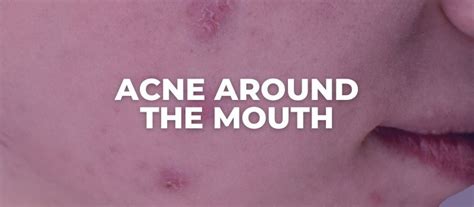 Acne Around The Mouth What Causes It And What Does It Mean
