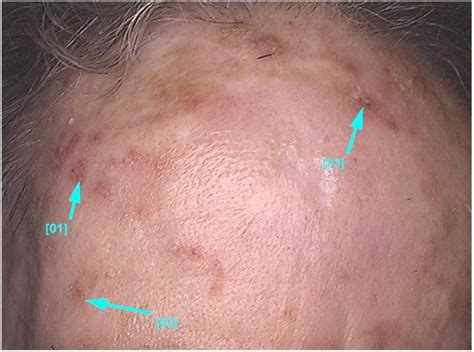 Actinic Keratoses Review Of Clinical Dermoscopic And Therapeutic