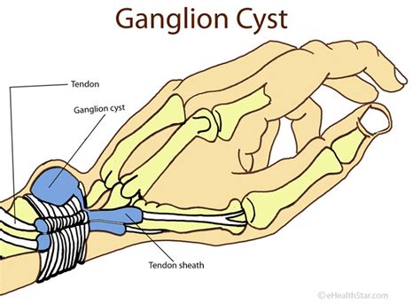 The dorsal radial zone is the area of the wrist near the thumb over the palm side. Ganglion Cyst (Wrist, Knee, Foot, Ankle) Pictures, Surgery ...