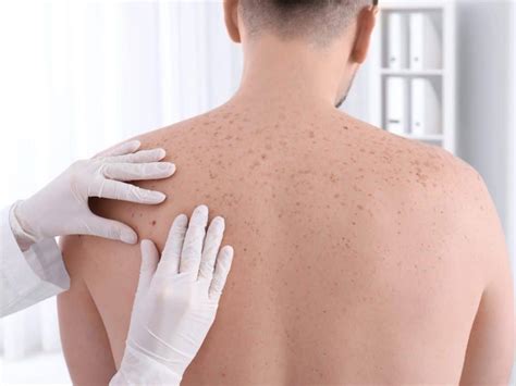 Câncer de pele conheça os principais sintomas e cuidados