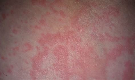 How To Get Rid Of Papule Acne Bumps Under Skin And Rash Treatment