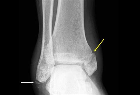 Avulsion Fracture Ankle Of The Talus Causes An Oblique Medial