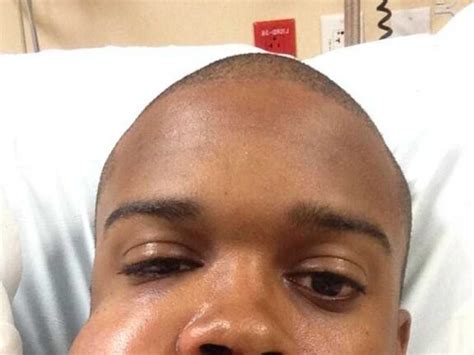 Baseball Player Takes Gruesome Selfie After Getting Hit In The Face