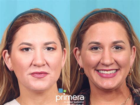 Endoscopic Forehead Lift Before And After Pictures Case 839 Orlando