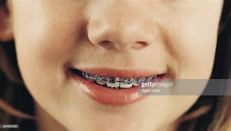 Closeup Of Girls Mouth With Braces On Her Teeth Photo Getty Images