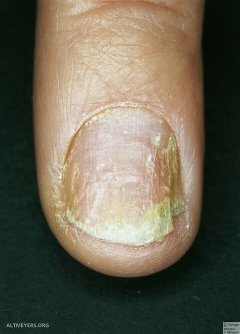 Distal And Lateral Subungual Onychomycosis