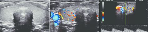 Normal Thyroid Gland A Gray Scale Ultrasound Transverse Scan