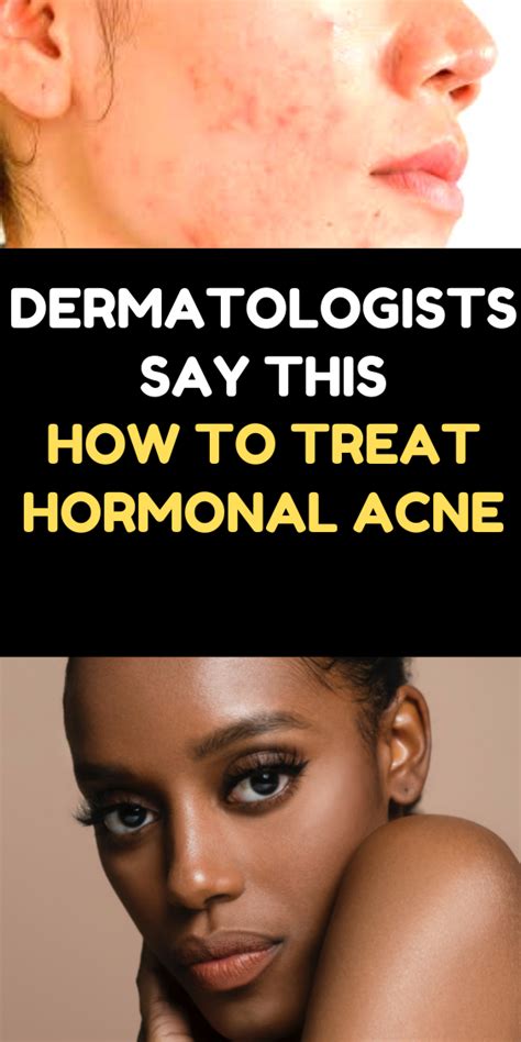 Dermatologists Say This Is How To Treat Hormonal Acne Nas Kobby Studios
