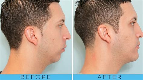 Jawline Exercise For Men Before And After Youtube