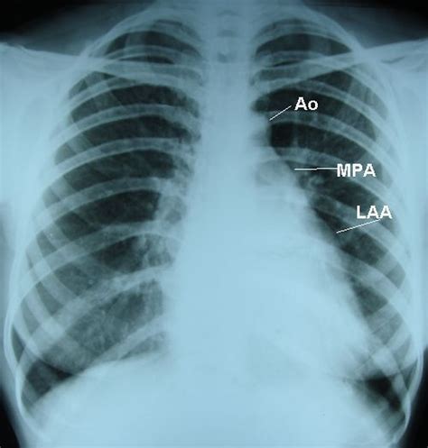 Mitral Stenosis Straightening Of Left Border X Ray Chest Pa View