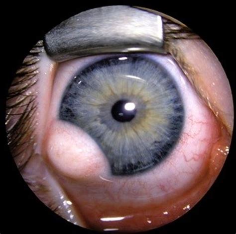 Cureus Successful Management Of Limbal Dermoid In Infancy And