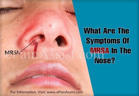 What Are The Symptoms Of Mrsa In The Nose