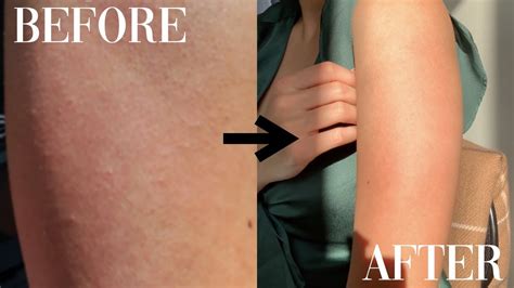 HOW I CLEARED MY KP KERATOSIS PILARIS ACNE 2 YEAR UPDATE Before
