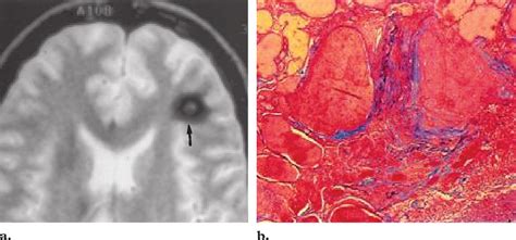 Cavernous Angioma A Axial T2 Weighted Mr Image Of The Brain Shows A