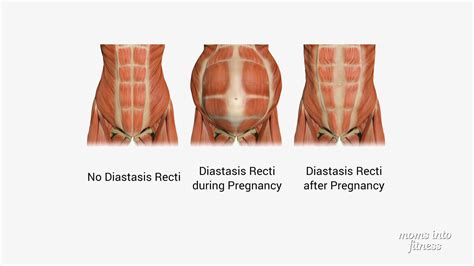 Intro Diastasis Recti Program Ab Rehab Diastasis Recti Diastasis What Is Diastasis Recti