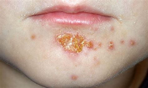 Impetigo 5 Favourite Remedies