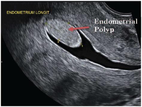 Endometrial Polyps Pathogenesis Sequelae And Treatment Njume Peter